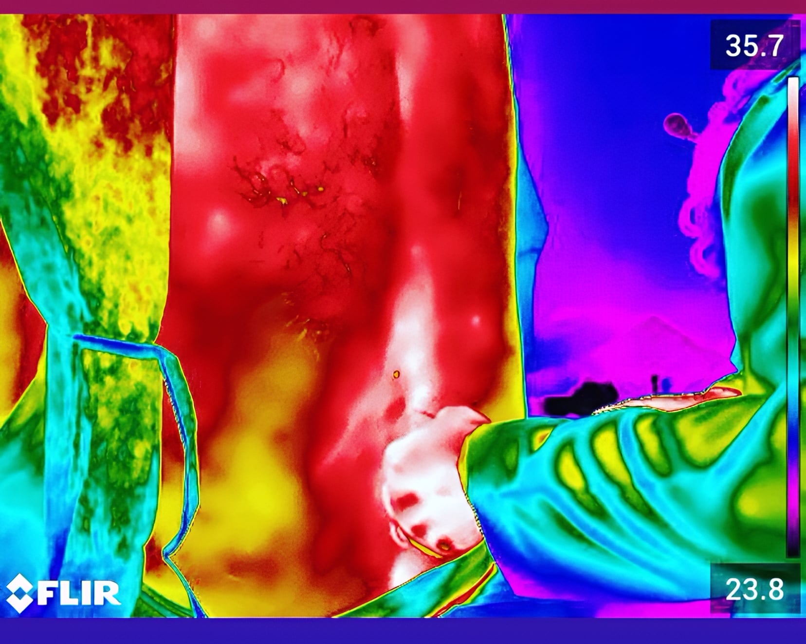 Ozonioterapia Termoguiada
